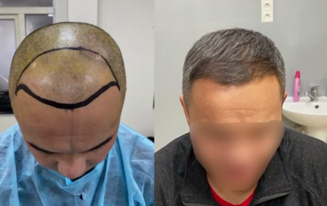Эми мамлекеттик ооруканалар да чач өстүрүү кызматын көрсөтүп баштайт