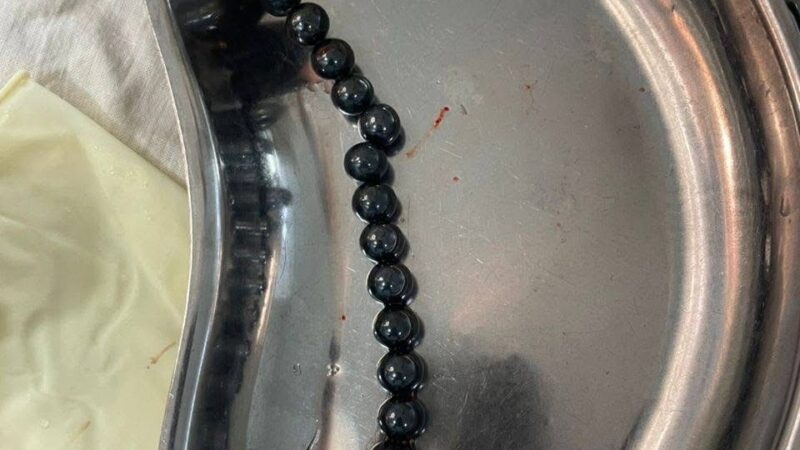 Ошто 2 жашар баланын ичинен 17 даана магниттик оюнчук алып чыгышты