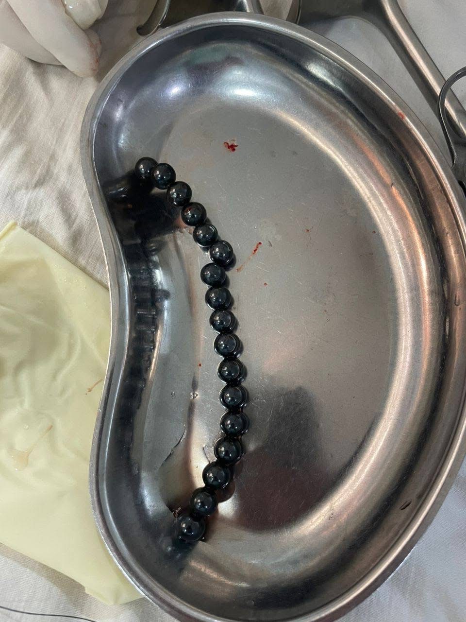 Ошто 2 жашар баланын ичинен 17 даана магниттик оюнчук алып чыгышты